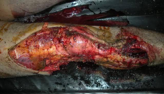 lacerated-wound-leg.jpg